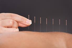 acupuncture for the treatment of long-covid
